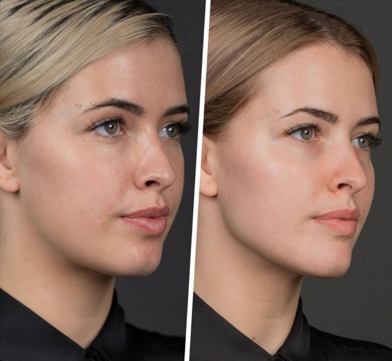 dermal filler treatment 768x708